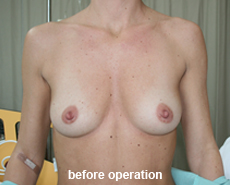 plastic-surgery-breast-augmentation